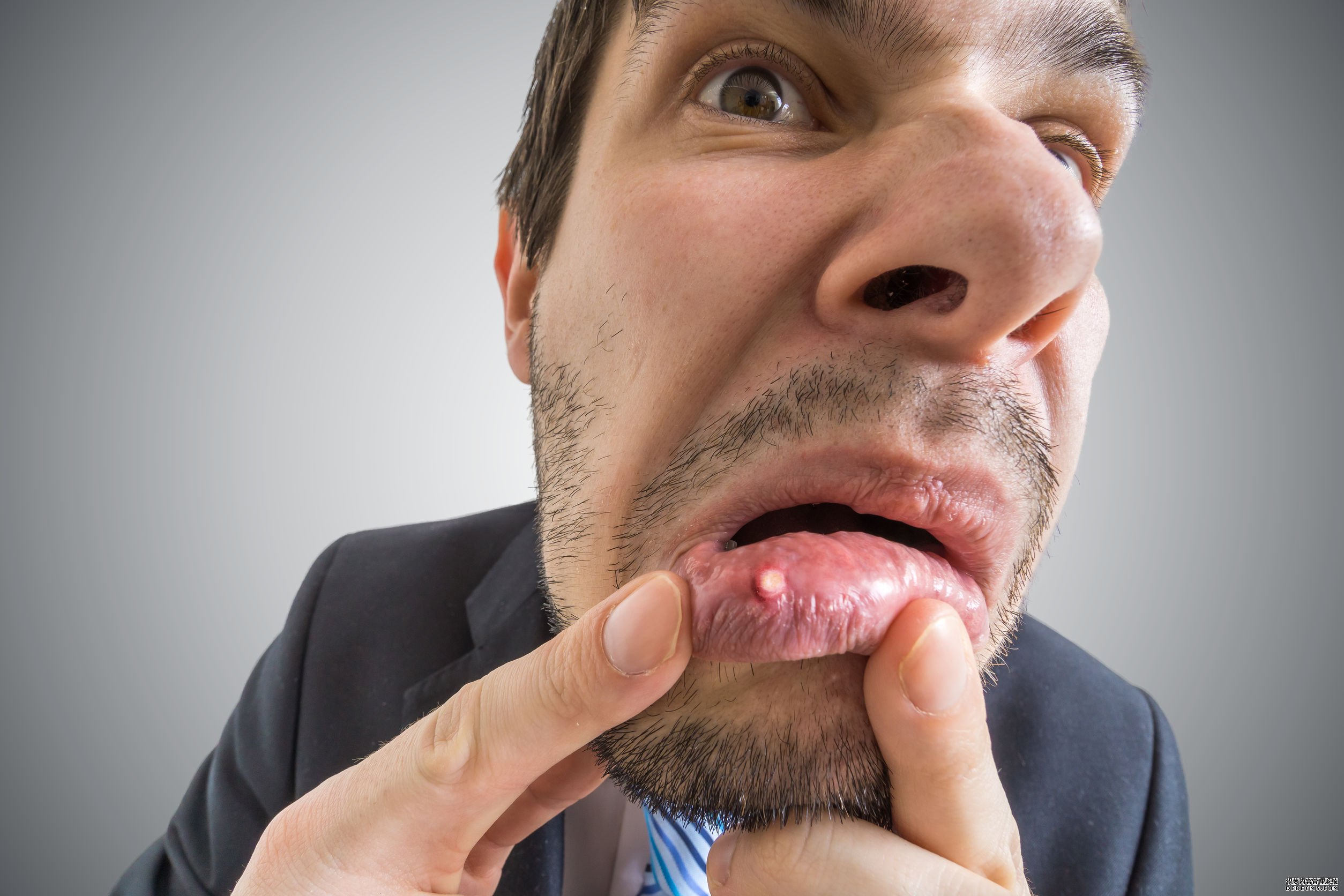 口疮与口腔溃疡的区别和鹅口疮与口腔溃疡一样吗？