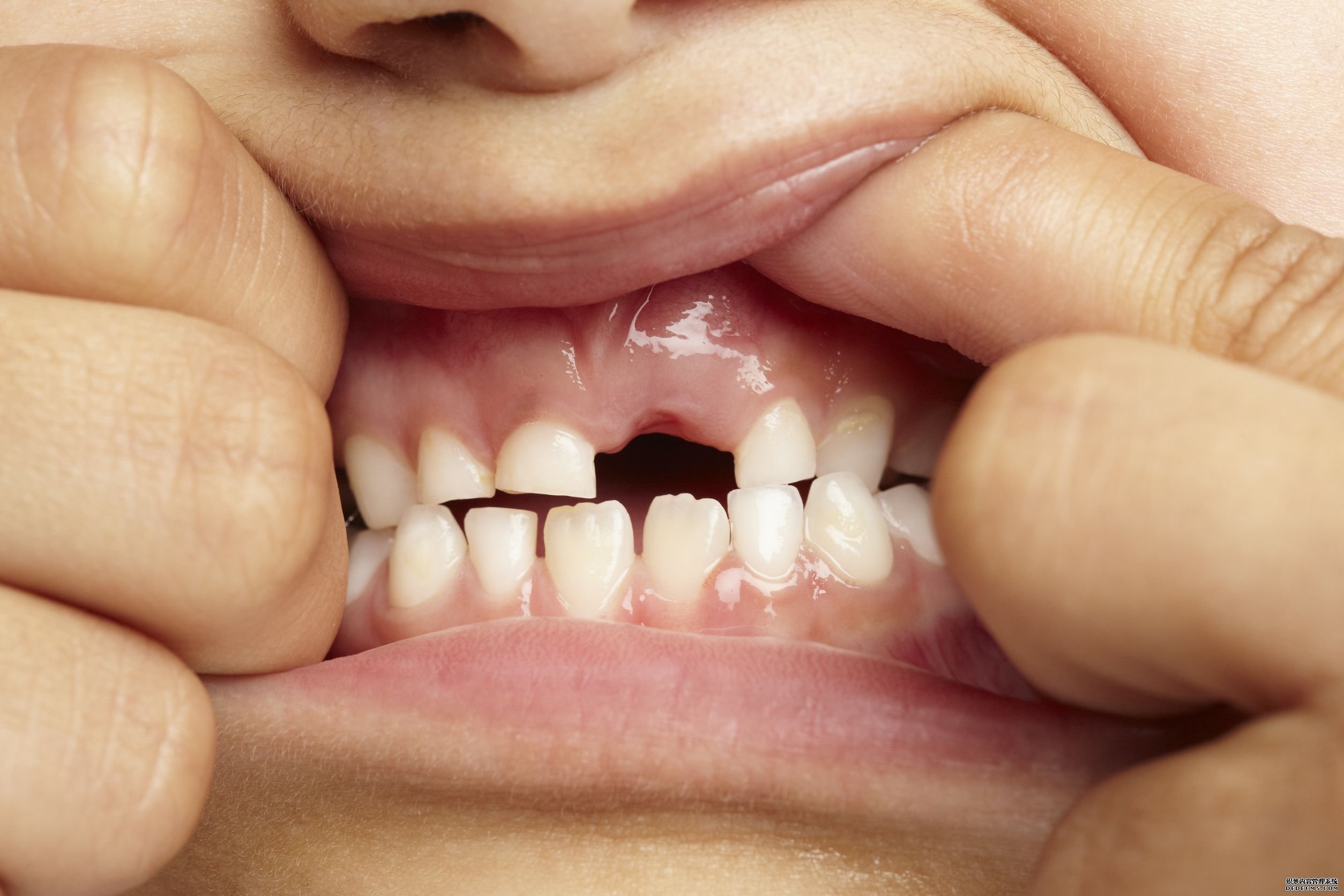 种植牙、镶牙、配假牙不是同一个科室的...