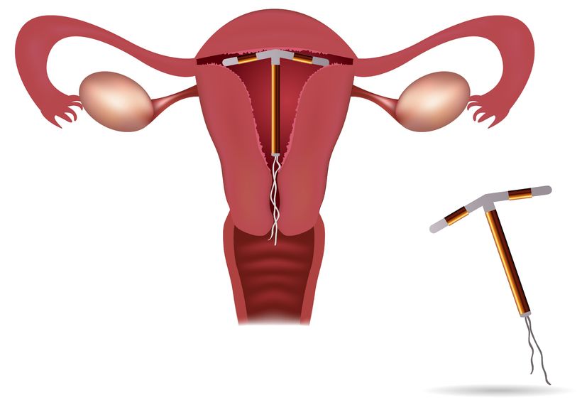 误区二:避孕环可长期使用         避孕环即节育环,是避孕方式之一
