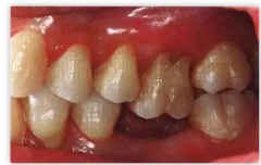 戴假牙会引起多种口腔病！缺牙者该如何选择修复方式？