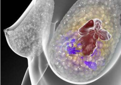 乳腺密度成为乳腺癌发病关键因素