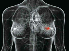 乳腺癌内分泌治疗药物及副作用梳理