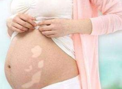 孕期和哺乳期白癜风，怎么办