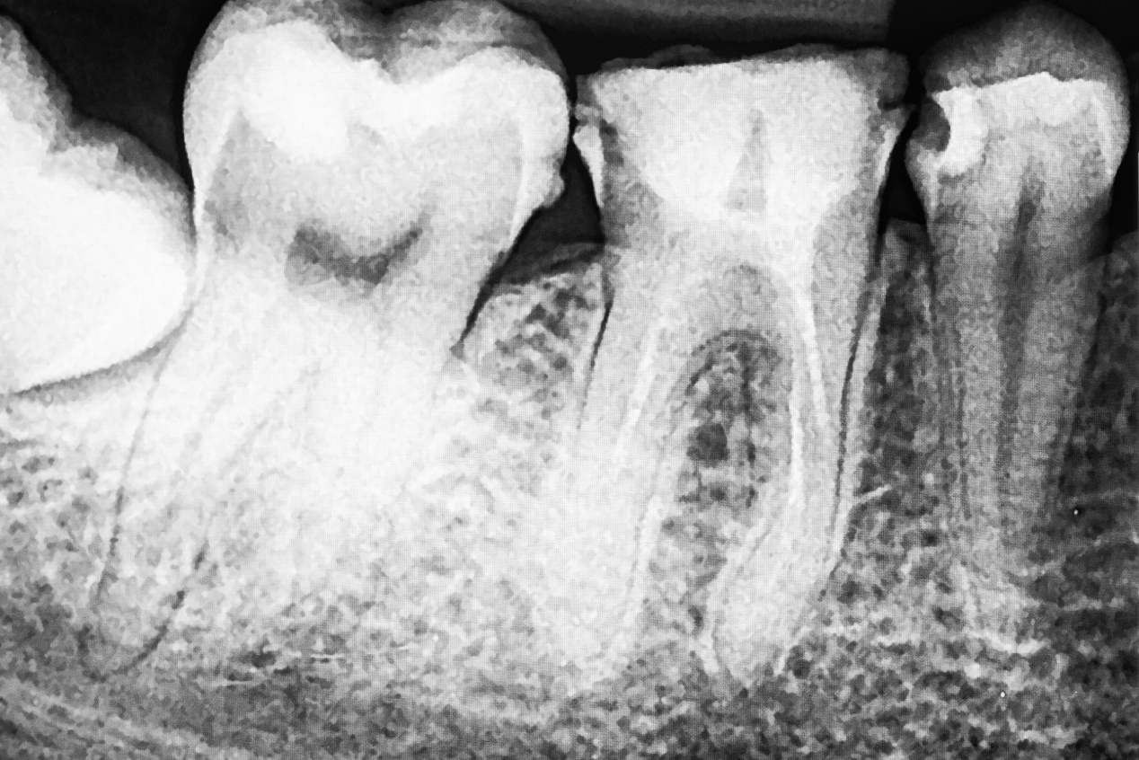 牙片怎么拍，什么情况下医生会建议拍？