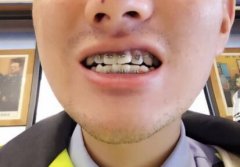 <b>金属矫正牙套近2年，侧颜酷似黄晓明</b>