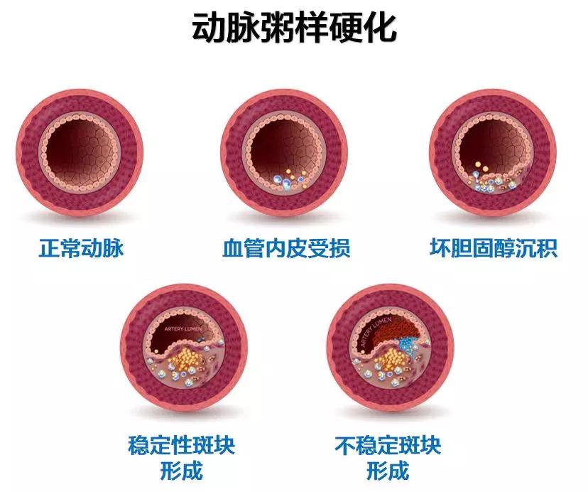 激烈运动,情绪波动,过度劳累等诱因的刺激下,不稳定斑块可能出现破裂