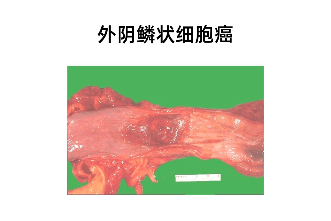 外阴癌__2025-02-13+15_28_28.png