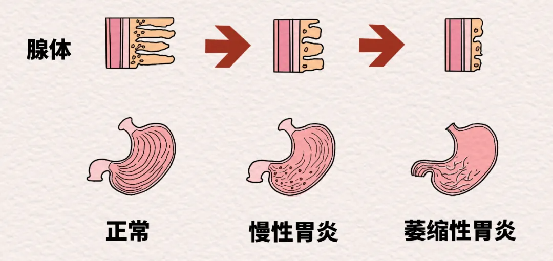 萎缩性胃炎，一场发生在胃粘膜的「水土流失」 - 医院汇 - 丁香园