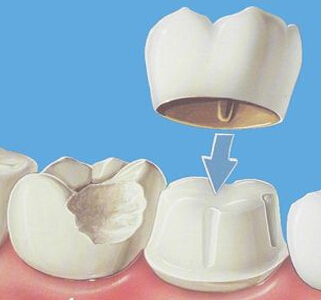 <b>需要做牙齿修复，你知道哪种材料好吗？</b>