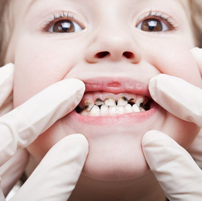 <b>蛀牙会不会遗传 营养牙床少蛀牙</b>