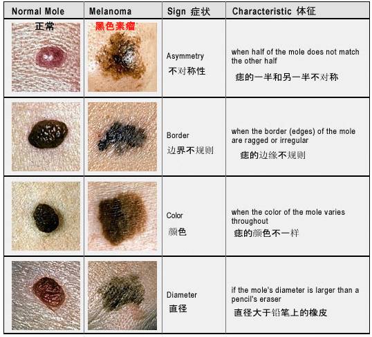 身上的痣出现这7种变化,要警惕癌变!