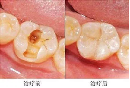 窟牙过程图片