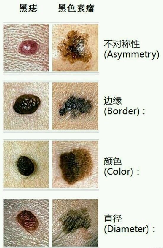 身上的痣会不会癌变?一张图告诉你