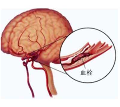 腦血栓_160資訊網_健康160旗下醫療信息門戶網站_中國人的在線健康